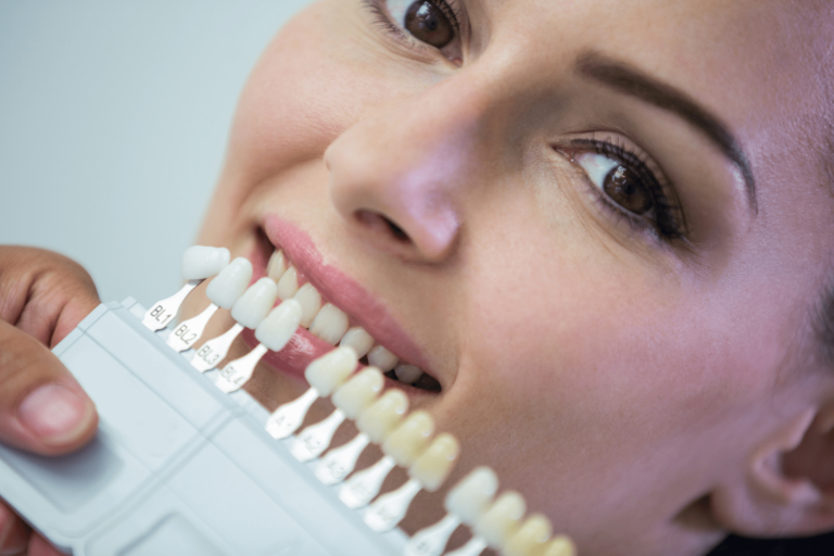 Dental Veneers Procedure: A Detailed Guide