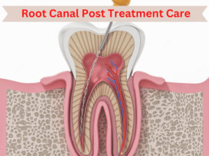 Root Canal Post Treatment Recovery Care