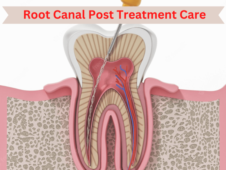 Root Canal Post-Treatment Care: Recovery Tips You Need to Know