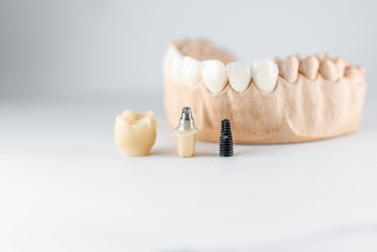 Dental Implants Dallas PA: A Solution That Lasts a Lifetime