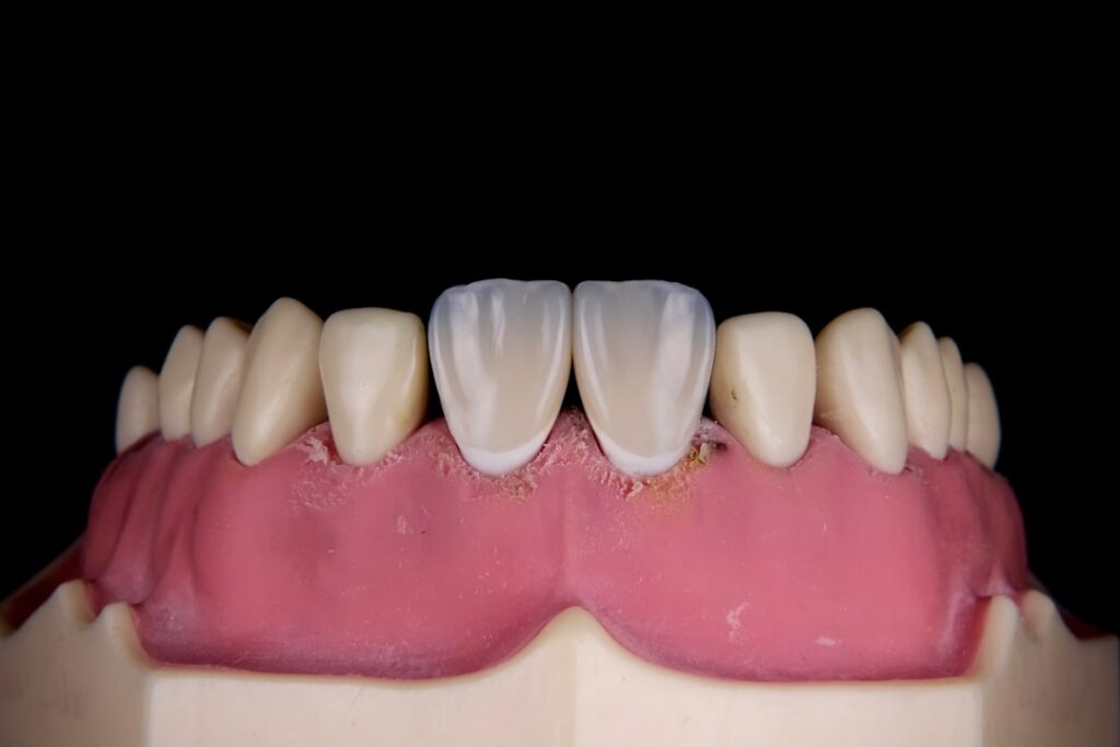 dental veneers guide