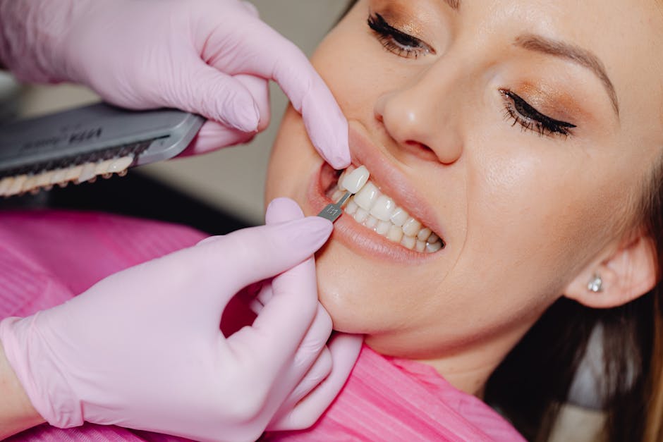 how long do veneers last