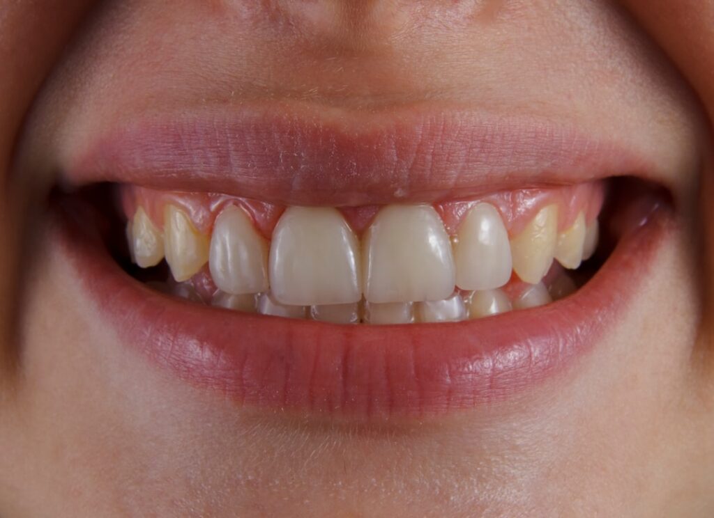 do veneers ruin your teeth