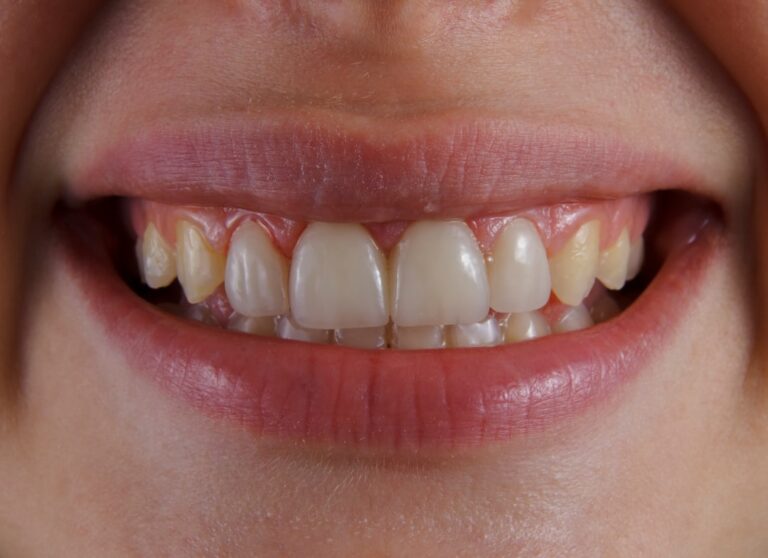 Do Veneers Ruin Your Teeth or Just Give Them a Makeover?