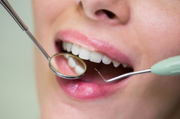 Don’t Ruin Your Smile: A Guide to Caring for Dental Veneers