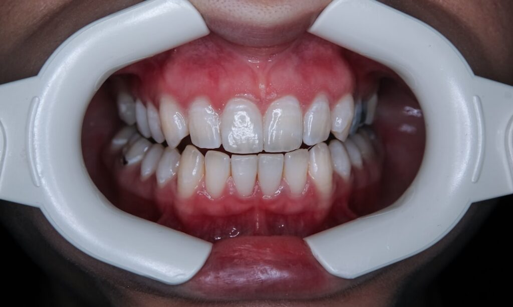 zoom teeth whitening bright white smile