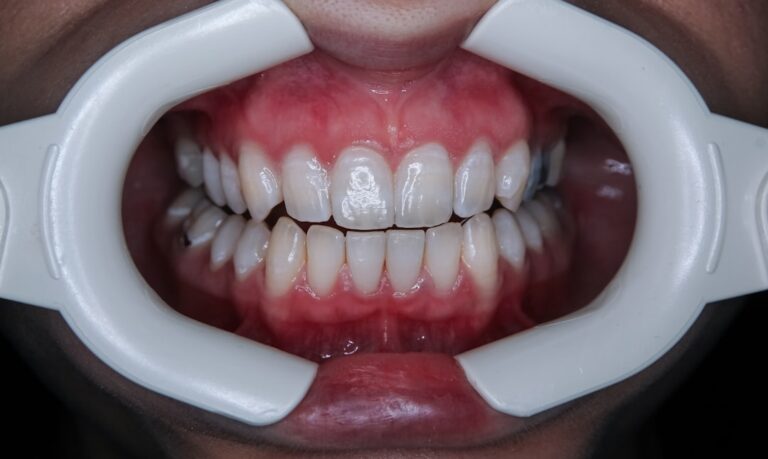 How Many Shades Whiter With Zoom Can You Actually Get
