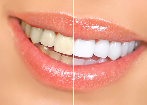 professional teeth whitening vs at home