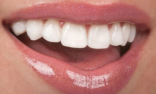 dental veneers process smile transformation cosmetic dentistry
